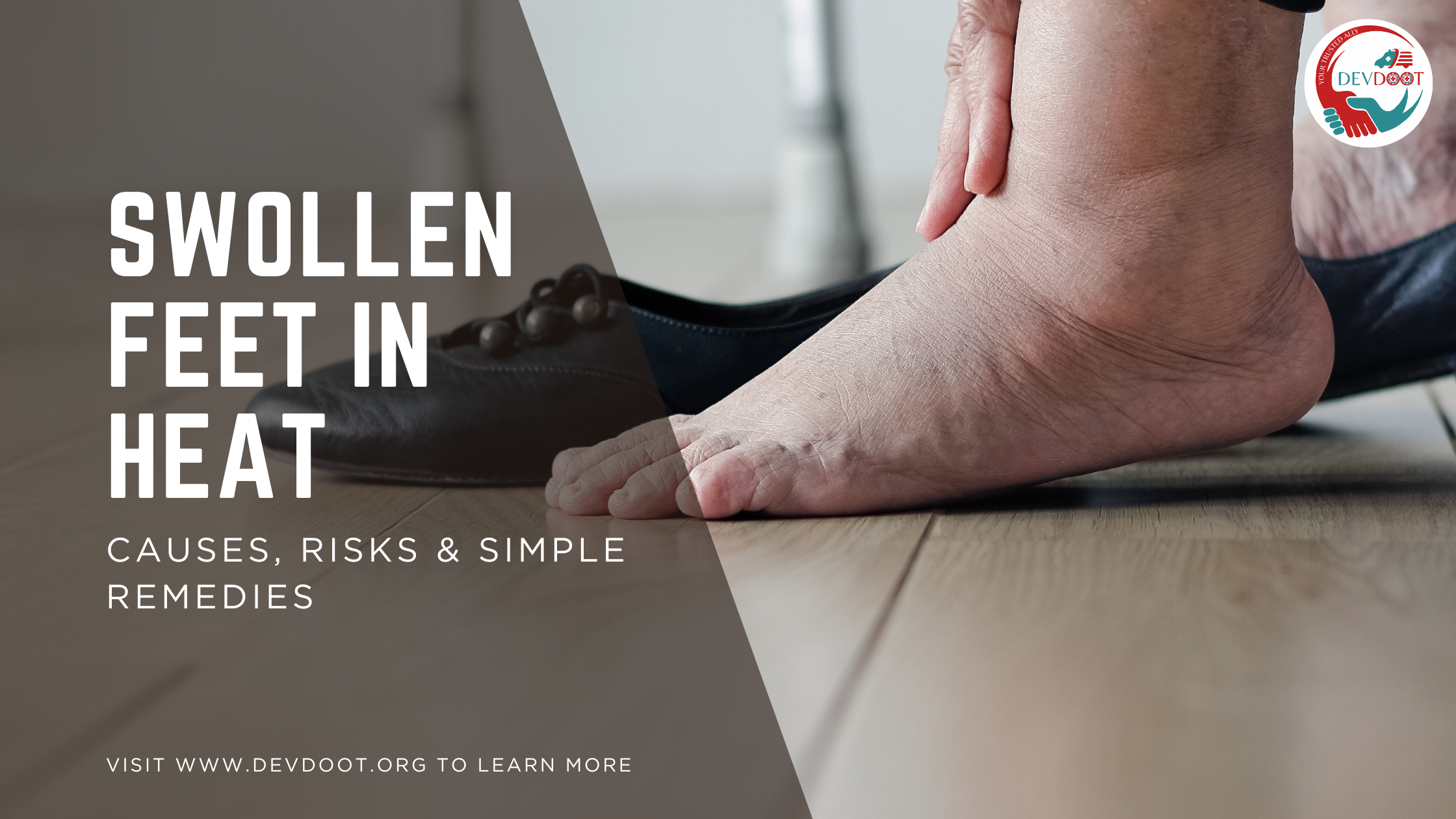 swollen feet in summer heat remedies